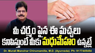 మీ చర్మం పైన ఈ మచ్చలు కనిపిస్తుంటే మీకు మధుమేహం ఉన్నట్లే! Skin changes in Diabetic Dermopathy.