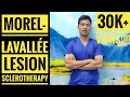 Morel-Lavallée Lesion Aspiration and Sclerotherapy