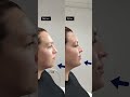 want to improve your side profile chin filler can be an amazing way of doing just that.