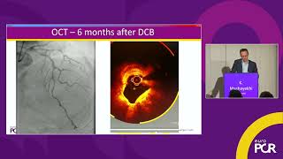 DCB in contemporary PCI: evidence, technique and physiology-guided decision-making - EuroPCR 2026