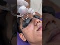 Erase Scars, Unveil Radiance: Laser Face Scar Removal Revealed!