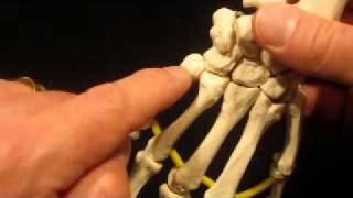 Common Metacarpal Subluxations