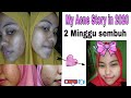 My acne story (perjalanan sembuh dari jerawat cuma 2 minggu)