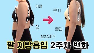 팔 지방흡입 2주차 벌써 효과가⁉️