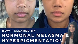 How I Cleared My MELASMA and HYPERPIGMENTATION using Hydroquinone