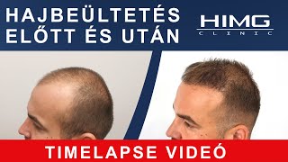 Hajbeültetés előtte utána: Tibor (TIMELAPSE VIDEÓ) - HIMG Hajbeültetési Klinika