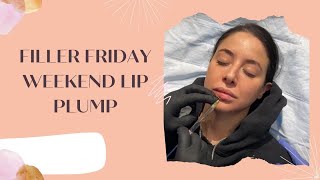 FILLER FRIDAY WEEKEND LIP PLUMP | Dr. Jason Emer