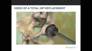 RebalanceMD Total Hip Replacement