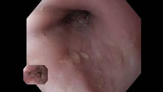 Boerhaave's Syndrome - Endoscopic Closure of Esophageal Perforation