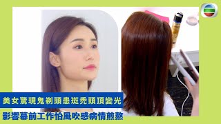 健康360 TVB｜美女驚現鬼剃頭患斑禿頭頂變光 影響幕前工作怕風吹感病情煎熬 斑禿屬自身免疫系統疾病皮膚毛囊被攻擊 40歲前發病嚴重連眉毛鬚根受影響 遺傳與壓力致脫髮應保持心境開朗｜最強生命線