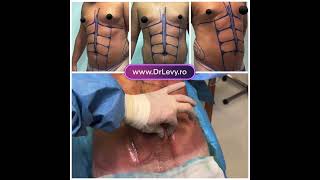 Cum ți se pare? Rezultat Before and After - Operație Liposucție Abdominală VASER PRO 4K [Dr. Levy]