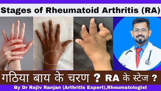 रूमेटाइड गठिया के चरण ? | Stages of Rheumatoid Arthritis ?