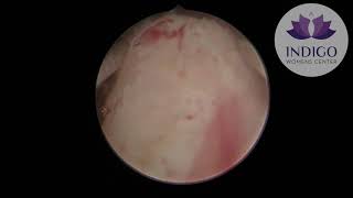 Hysteroscopic myomectomy for a sub mucous fibroid