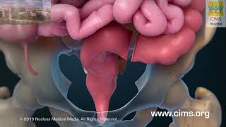 Rectum Removal (Gujarati) – CIMS Hospital