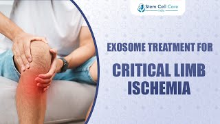 Exosome and Stem Cell Therapy for Critical Limb Ischemia: A Life-Saving Innovation |