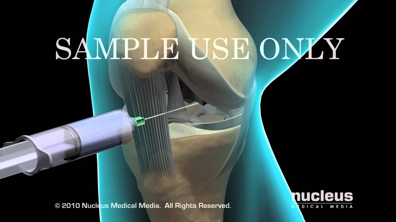 Knee Arthroscopy - YouTube