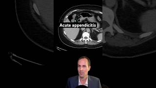 Abdominal CT Tutorials - Acute appendicitis