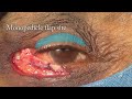 management of eyelid tumors wide excision biopsy u0026 eyelid reconstruction