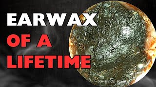 Earwax Of a Lifetime