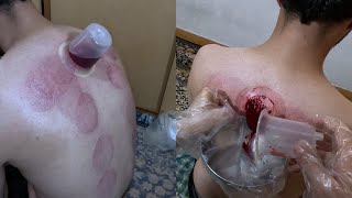 how to do cupping therapy at home?(hijama therapy) cupping therapy in iran #cupping #therapy #health