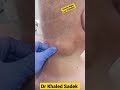 massive neck cyst #shorts tonight live dr khaled sadek