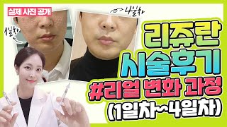 리쥬란 시술❗ 엠보싱 꼭 생기는건가요? 📌시술 방법에 따라 엠보싱이 다릅니다👉 시술 방법에 따라 1일차 ~ 4일차까지 전격비교