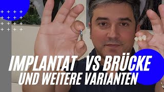 #Implantat oder #Brücke und weitere Varianten/5Möglichkeiten als Zahnersatz, #Klebebrücke | Maryland