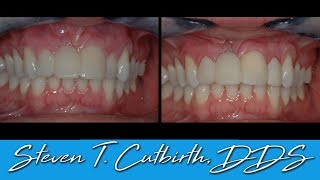 How to Add a Provisional to an Existing Provisional Restoration - with Steven T. Cutbirth, DDS