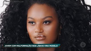 Brasileira com fissura labiopalatina posa para revista e vira modelo de batom.