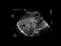 ultrasound of the liver