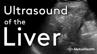 Ultrasound of the Liver