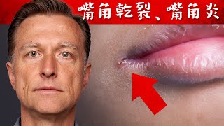 嘴角乾裂、嘴角炎, 缺少營養素,自然療法,柏格醫生 Dr Berg