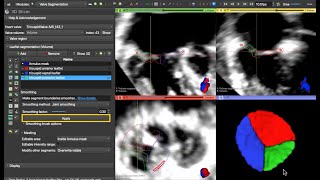 Tricuspid Valve in HLHS Fontan: Annular Modeling, Segmentation, \u0026 Quantification in 3D Slicer