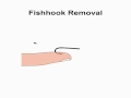 Animated Fish Hook Removal - String yank technique by NetKnots