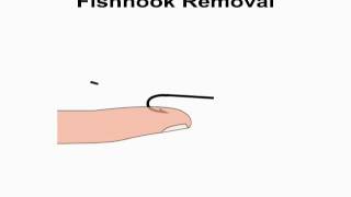 Animated Fish Hook Removal - String yank technique by NetKnots