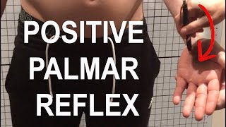 Primitive Reflexes Positive Palmar/Grasp Reflex in an Adult | Posturepro