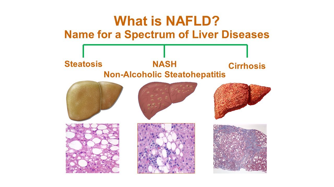 What Is Non-Alcoholic Fatty Liver Disease (NAFLD)? - YouTube