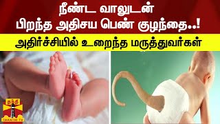 நீண்ட வாலுடன்  பிறந்த அதிசய பெண் குழந்தை..! அதிர்ச்சியில் உறைந்த மருத்துவர்கள் | New Born Baby