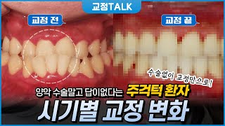 모든 치과에서 양악 수술을 추천한 아랫니가 거꾸로 물린 역대급 교정 환자! 🦷 수술 없이 교정할 수 있나요?ㅣ💙교정TALK🦷