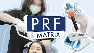 PRF MATRIX ฉีดกระตุ้นรากผม เร่งการงอก เห็นผลกว่า PRP 10เท่า !!