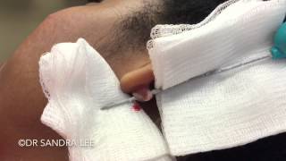 Keloid treatment with cryoshape (her second treatment). For medical education- NSFE.