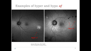 Best practices for utilizing FAF \u0026 UWF retinal imaging in the optometric practice