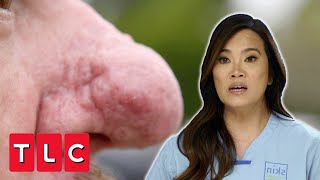 Dr Lee Reconstructs A Nose With Rhinophyma | Dr Pimple Popper Pop Up | CENSORED