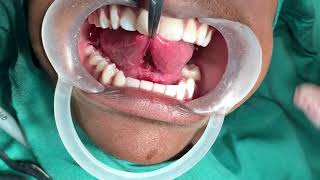 Ankyloglossia - Tongue tie release surgery