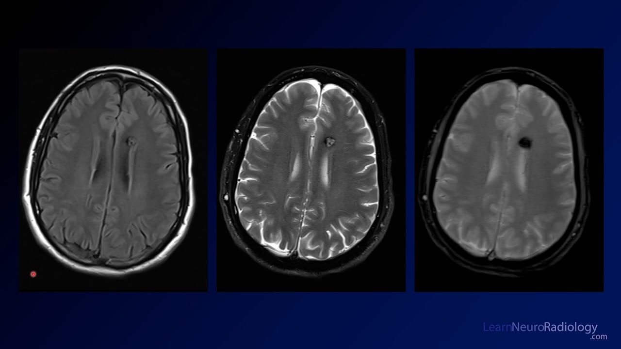 Neuroradiology Board Review - Brain Tumors - Case 12 - YouTube