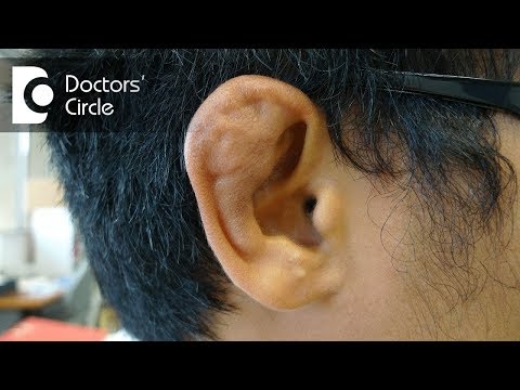 What causes Cauliflower Ear? - Dr. Gayatri S Pandit What causes Cauliflower Ear? - Dr. Gayatri S Pandit