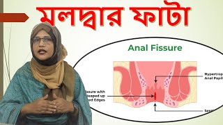 মলদ্বার ফাটা । Rectal Fissure । Anal Fissure Treatment Homeopathy । Dr Hosneara Pervin