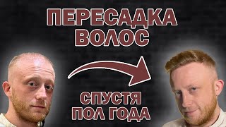 Результат пересадки волос | Нужна ещё одна? | Процесс восстановления