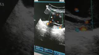 25/f 7weeks 2days mild blooding present time heart rate not show