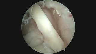 A Novel Arthroscopic Inside-Out Repair Technique for PASTA Lesions